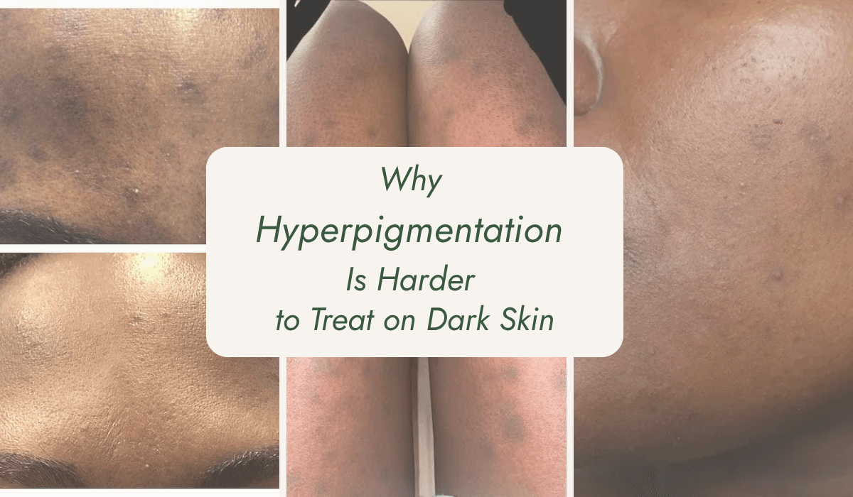 A collage of three images showing hyperpigmentation on face and tighs.